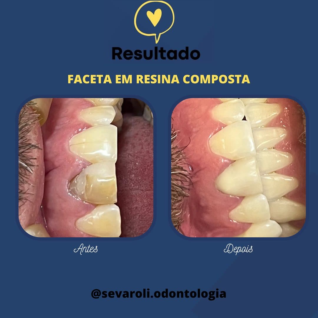 FACETA EM RESINA COMPOSTA