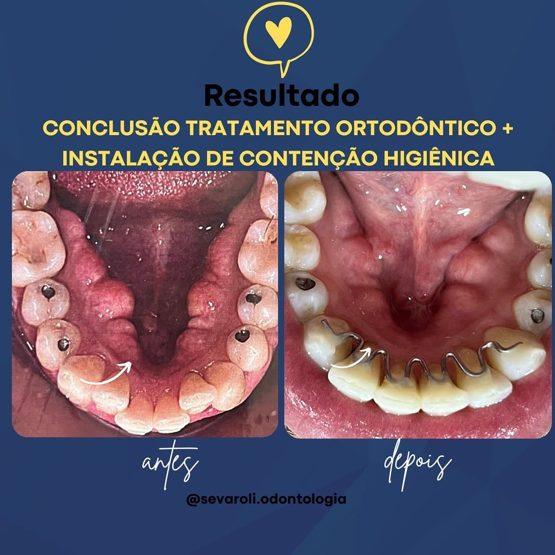 CONCLUSÃO TRATAMENTO ORTODÔNTICO + INSTALAÇÃO DE CONTENÇÃO HIGIÊNICA