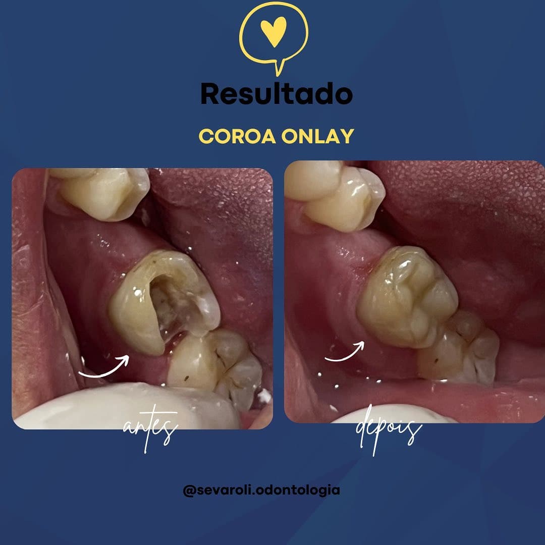 COROA ONLAY