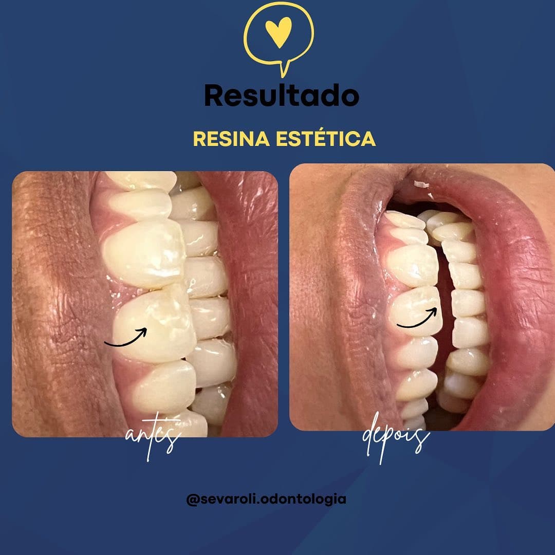 RESINA ESTÉTICA