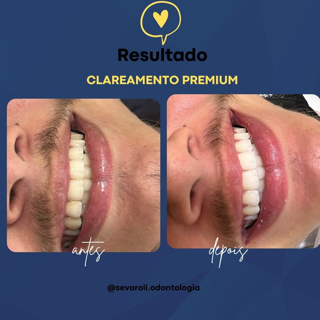 CLAREAMENTO PREMIUM