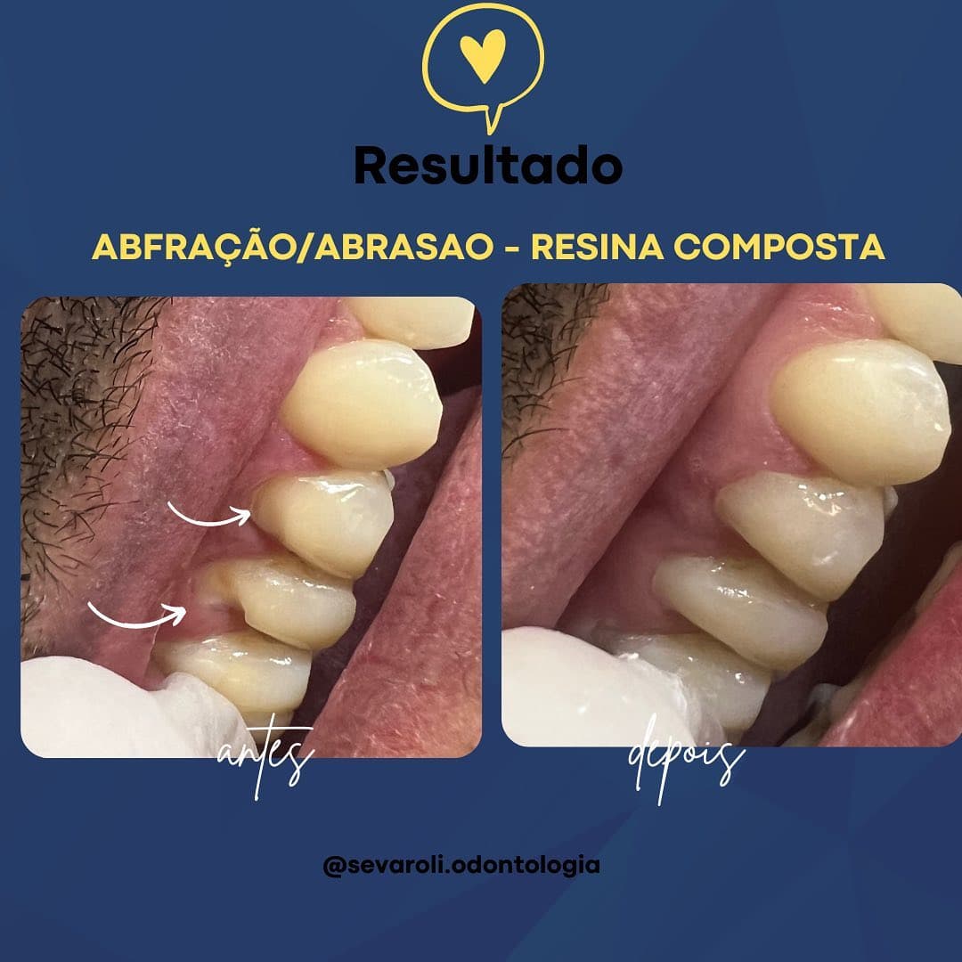 ABFRAÇÃO/ABRASAO - RESINA COMPOSTA