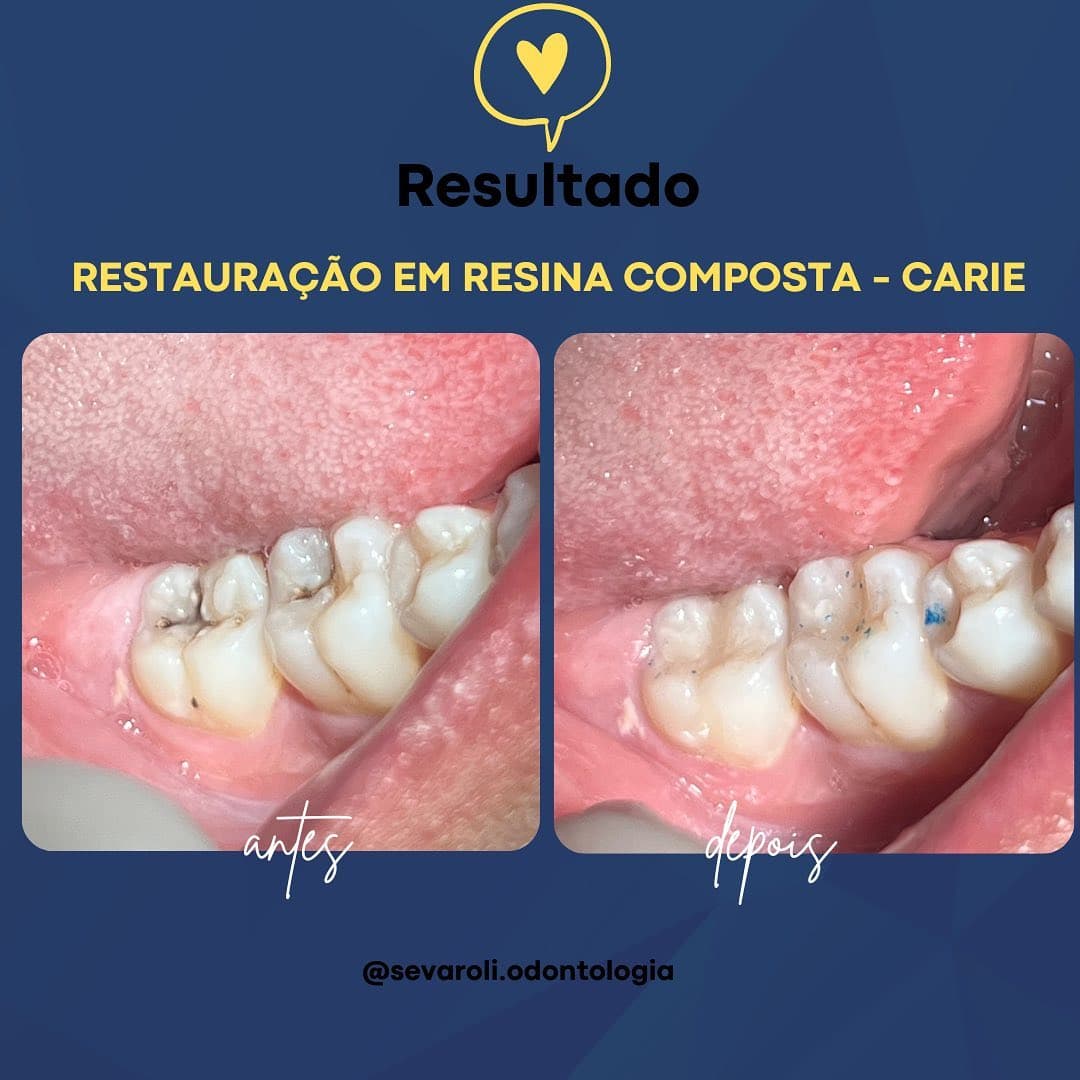 RESTAURAÇÃO EM RESINA COMPOSTA - CARIE