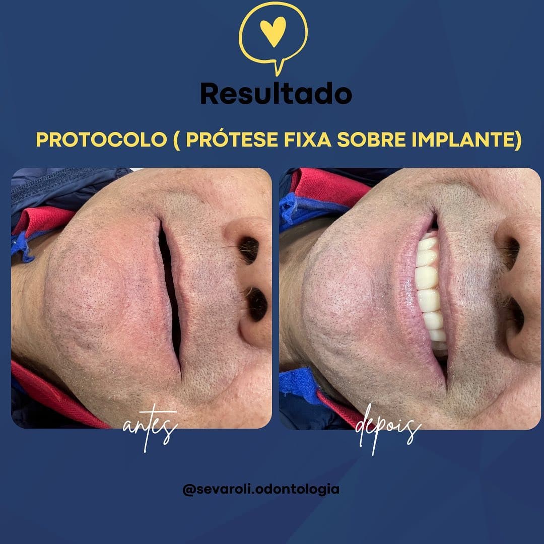 PROTOCOLO ( PRÓTESE FIXA SOBRE IMPLANTE)