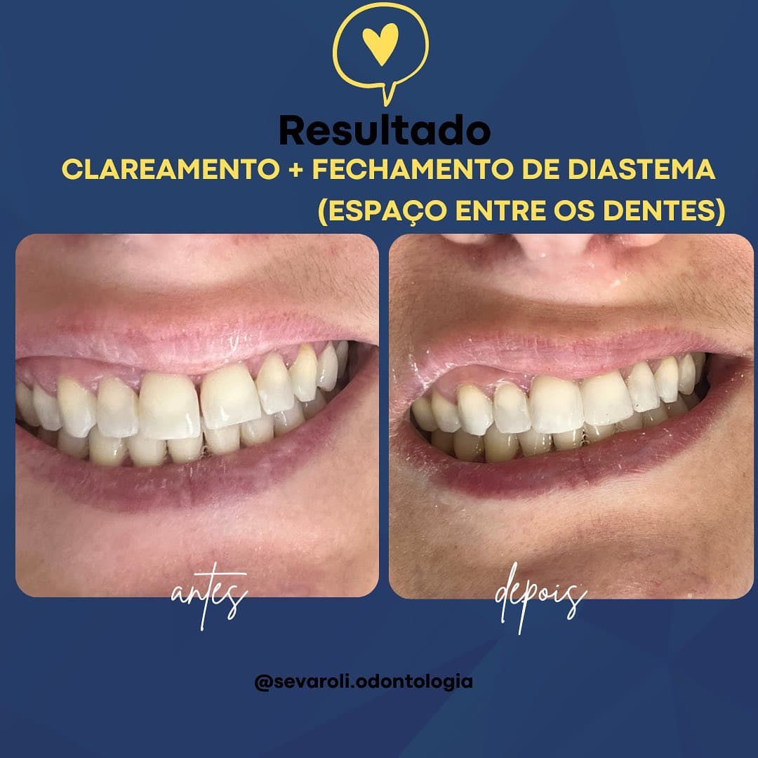 CLAREAMENTO + FECHAMENTO DE DIASTEMA (ESPAÇO ENTRE OS DENTES)